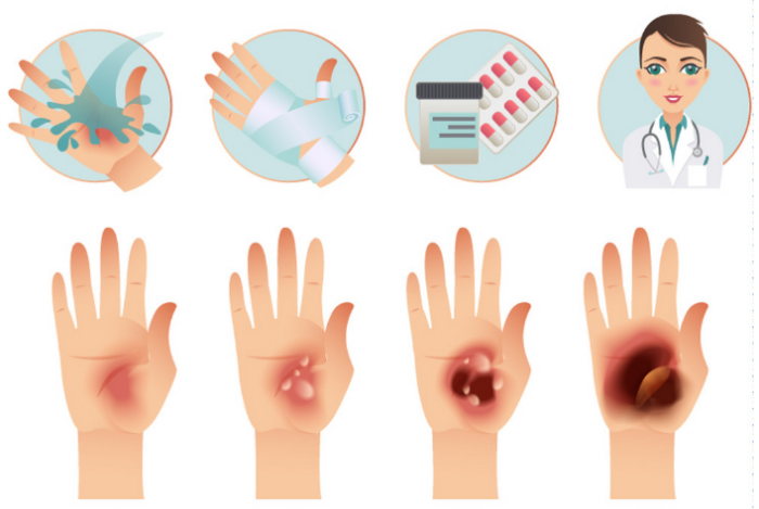 First Aid: Burns - Quick Course - Image 3